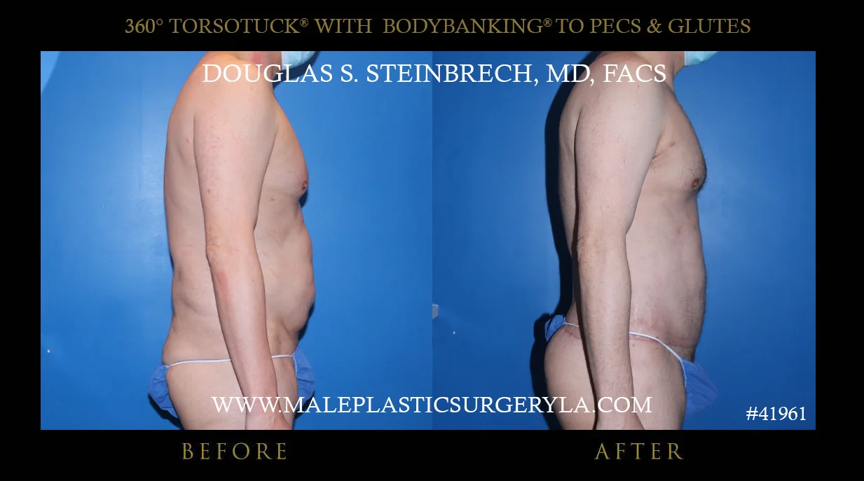 Torsotuck - Before & After Photos