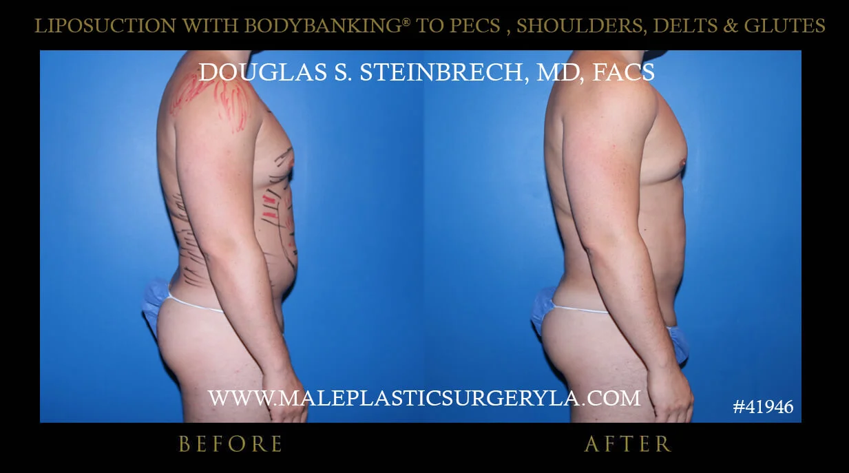 Liposuction - Before & After Photos