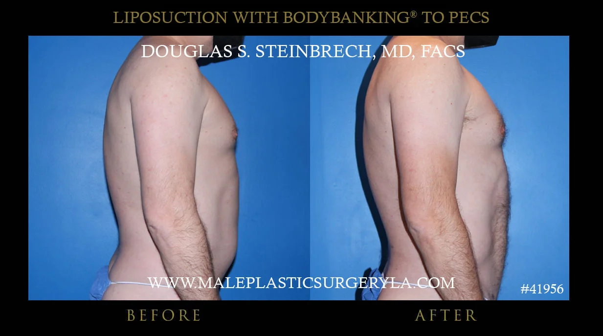 Liposuction - Before & After Photos