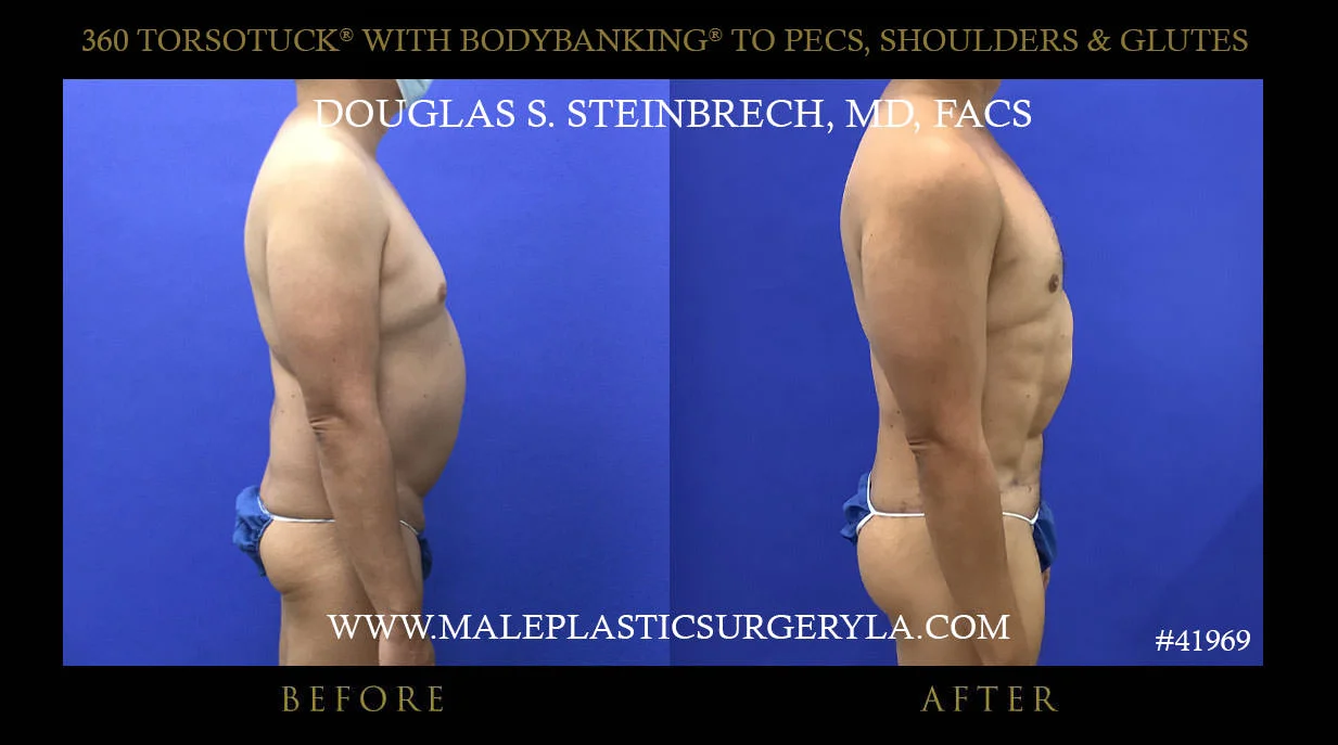 Torsotuck - Before & After Photos