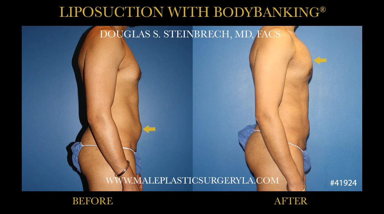 Liposuction - Before & After Photos