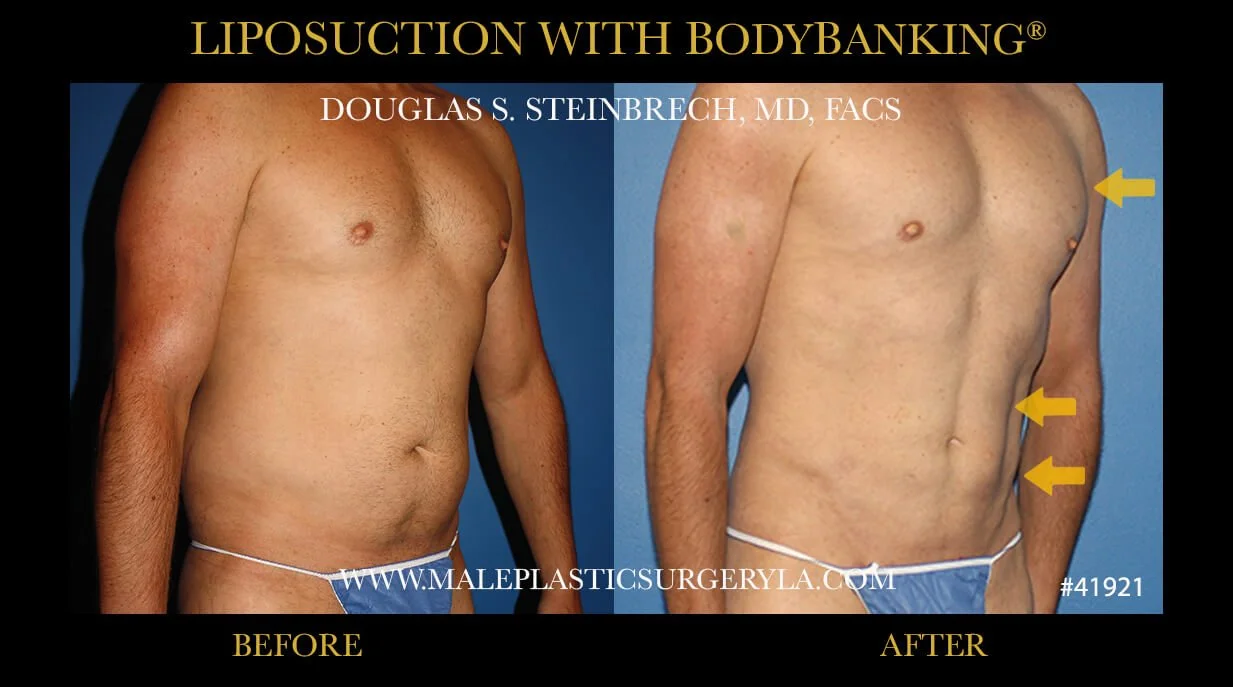 Liposuction - Before & After Photos