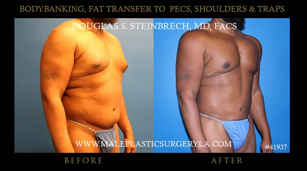 Liposuction - Before & After Photos