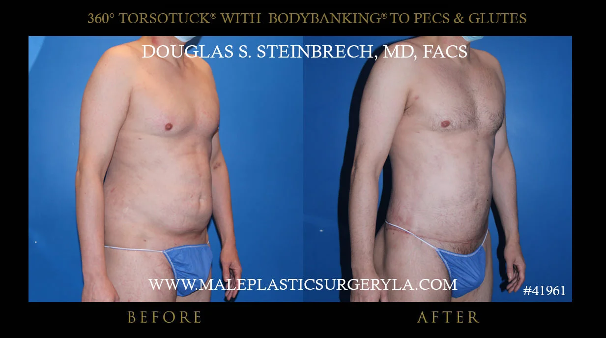 Torsotuck - Before & After Photos