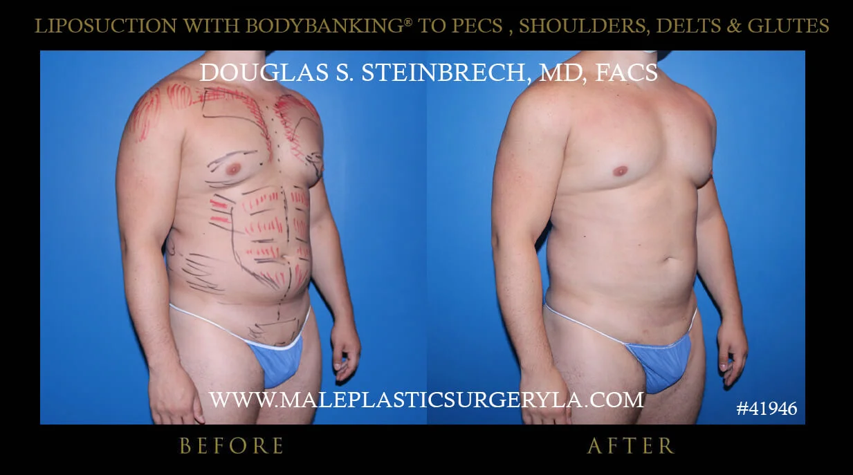 Liposuction - Before & After Photos