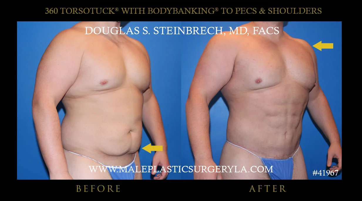 Torsotuck - Before & After Photos