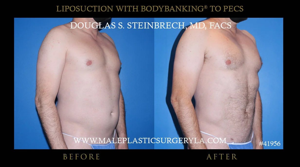 Liposuction - Before & After Photos