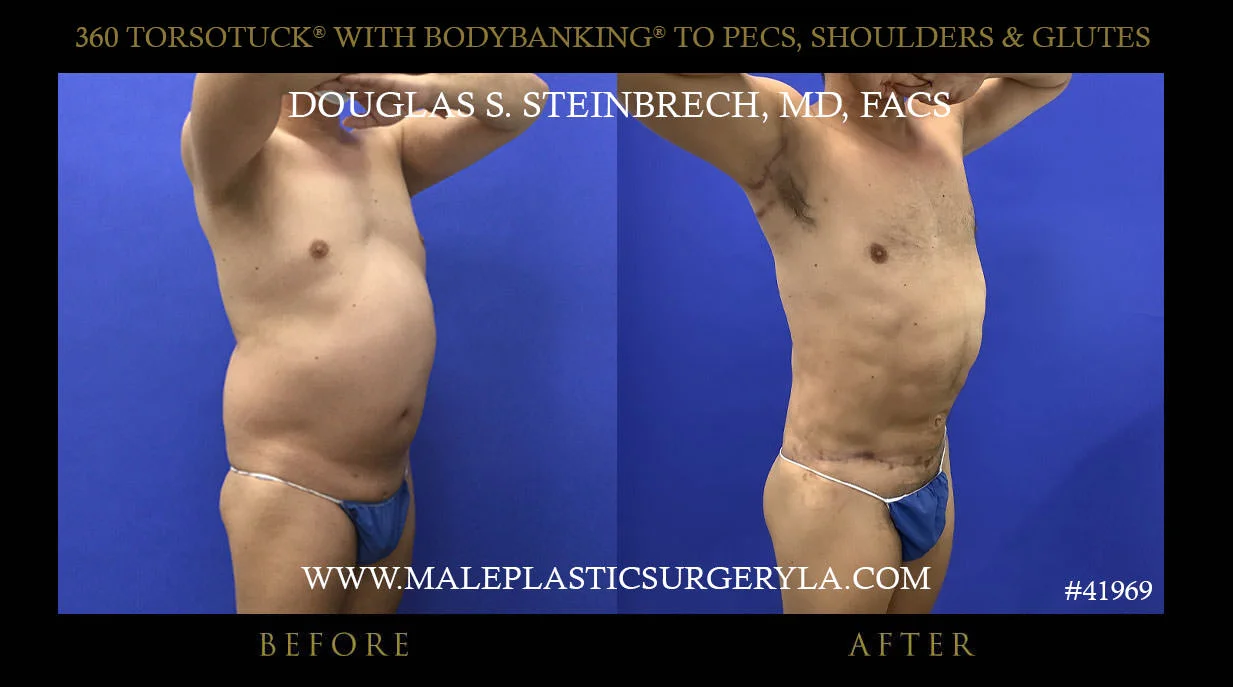 Torsotuck - Before & After Photos