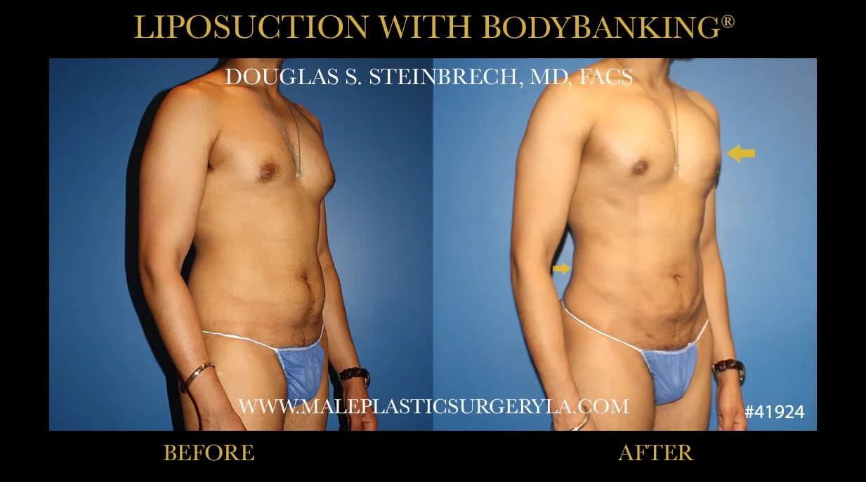 Liposuction - Before & After Photos