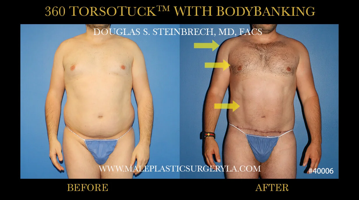 Torsotuck - Before & After Photos