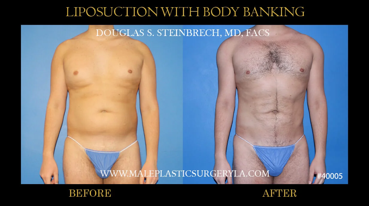 Liposuction - Before & After Photos