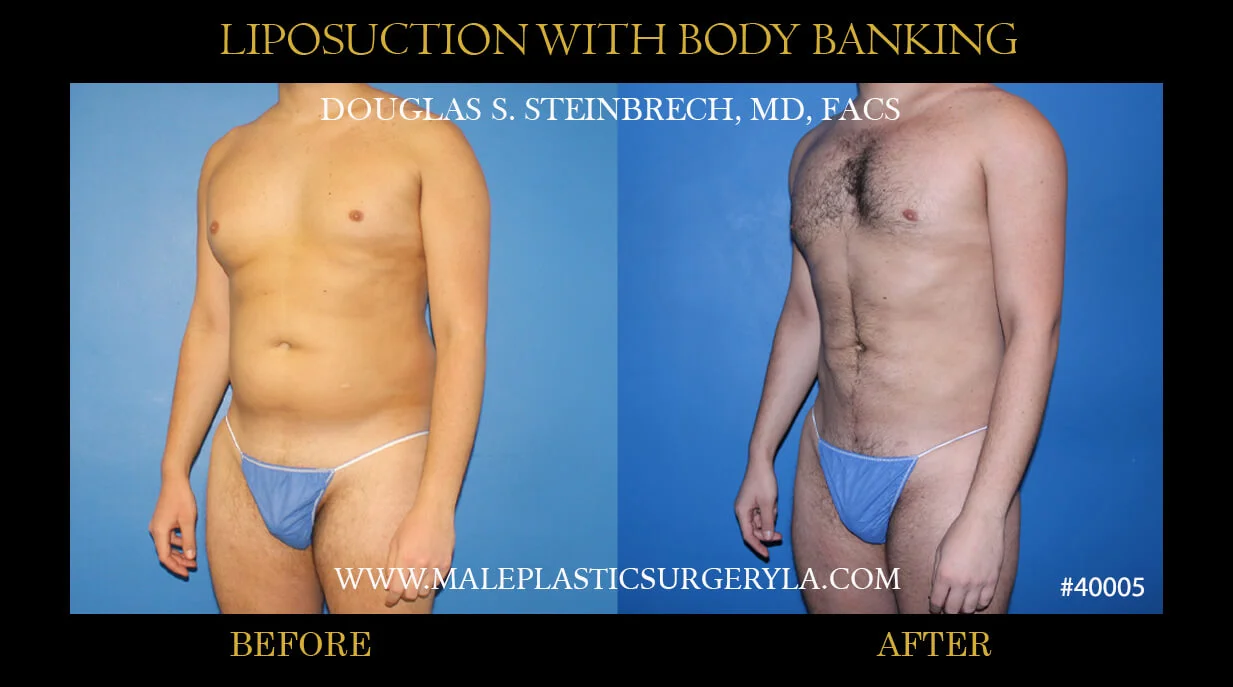 Liposuction - Before & After Photos