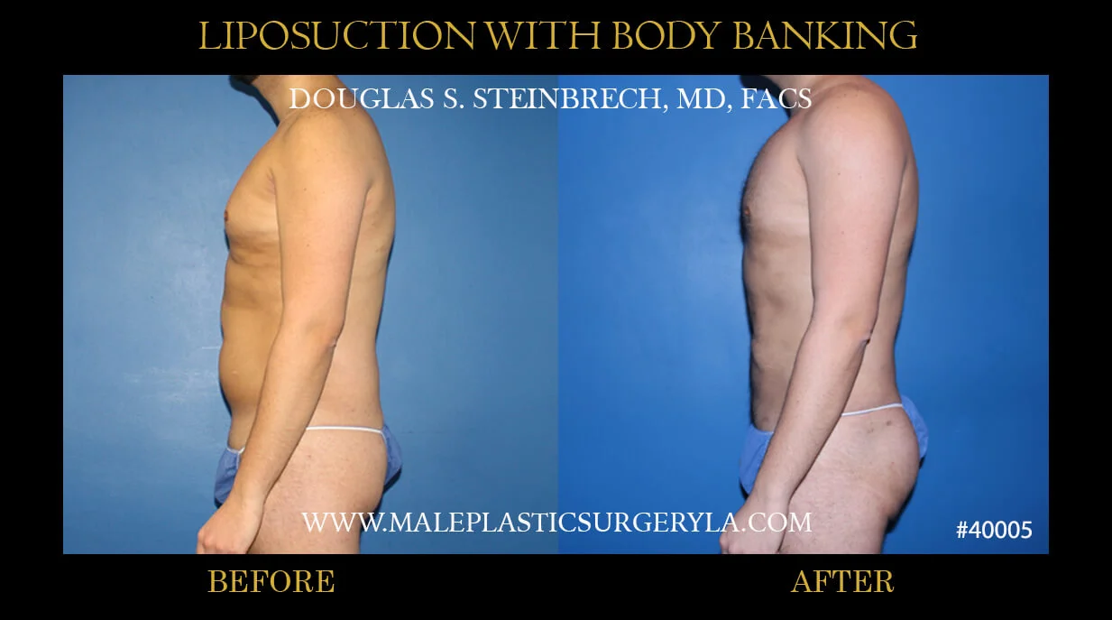 Liposuction - Before & After Photos