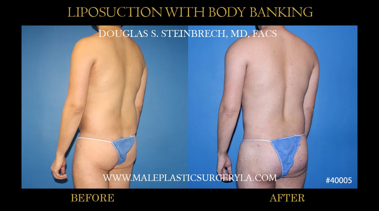 Liposuction - Before & After Photos