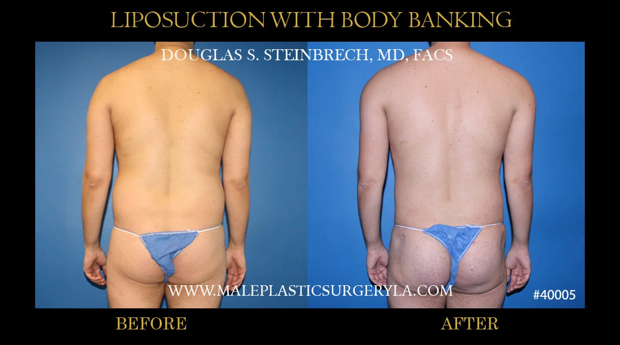 Liposuction - Before & After Photos