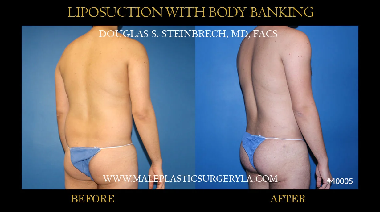 Liposuction - Before & After Photos