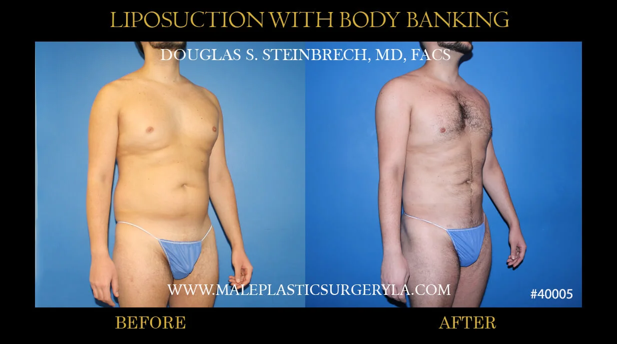 Liposuction - Before & After Photos