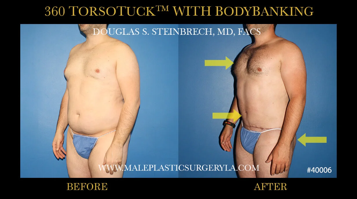 Torsotuck - Before & After Photos