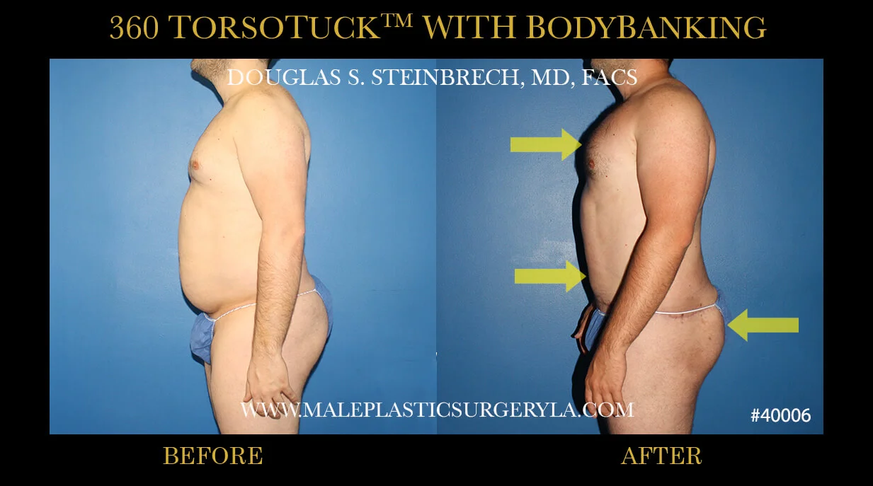 Torsotuck - Before & After Photos