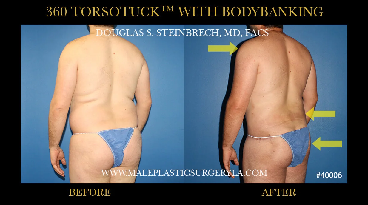 Torsotuck - Before & After Photos