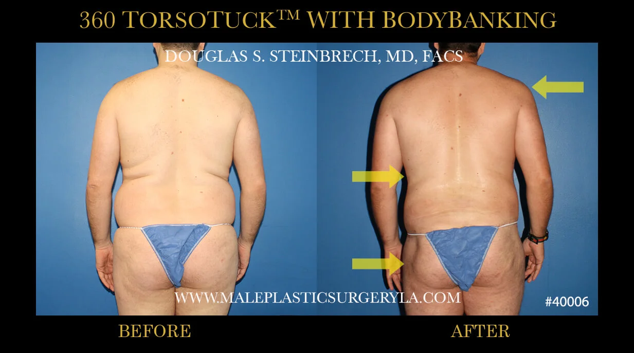 Torsotuck - Before & After Photos