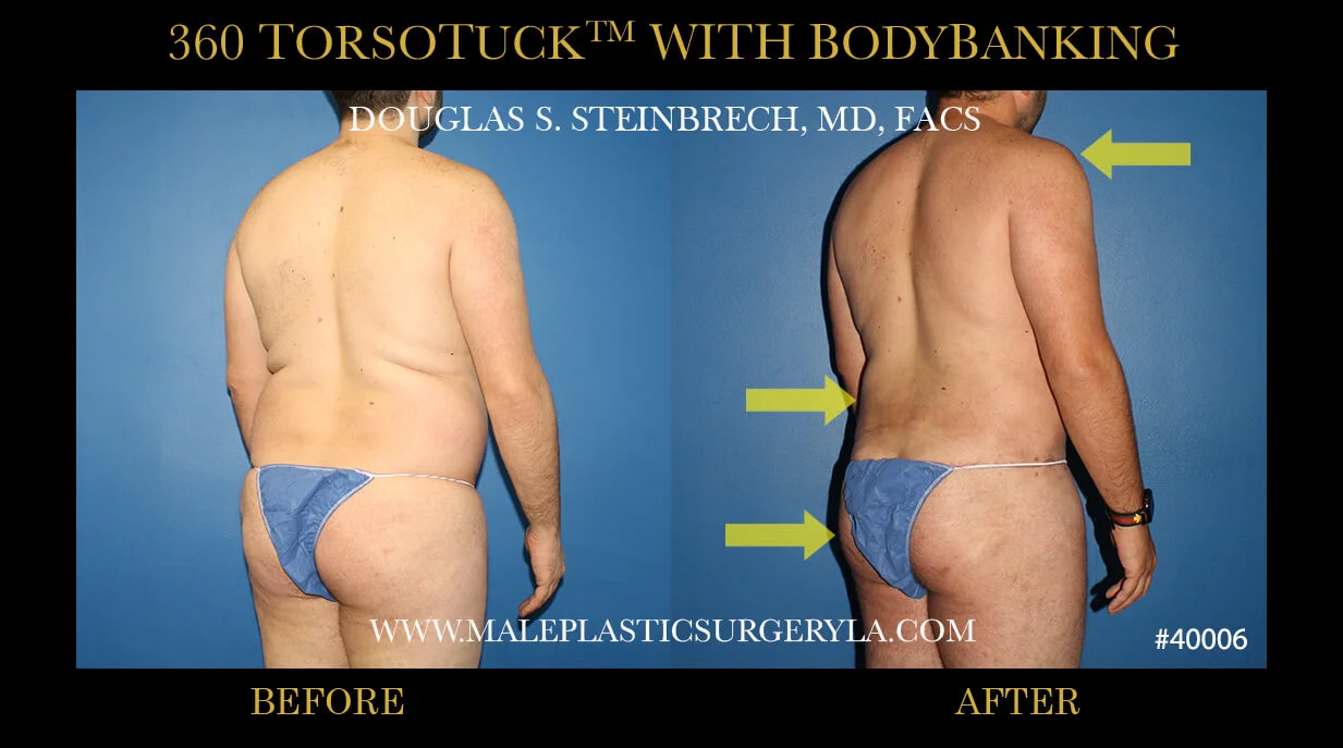 Torsotuck - Before & After Photos