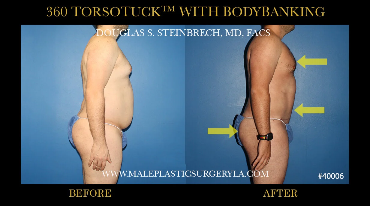 Torsotuck - Before & After Photos