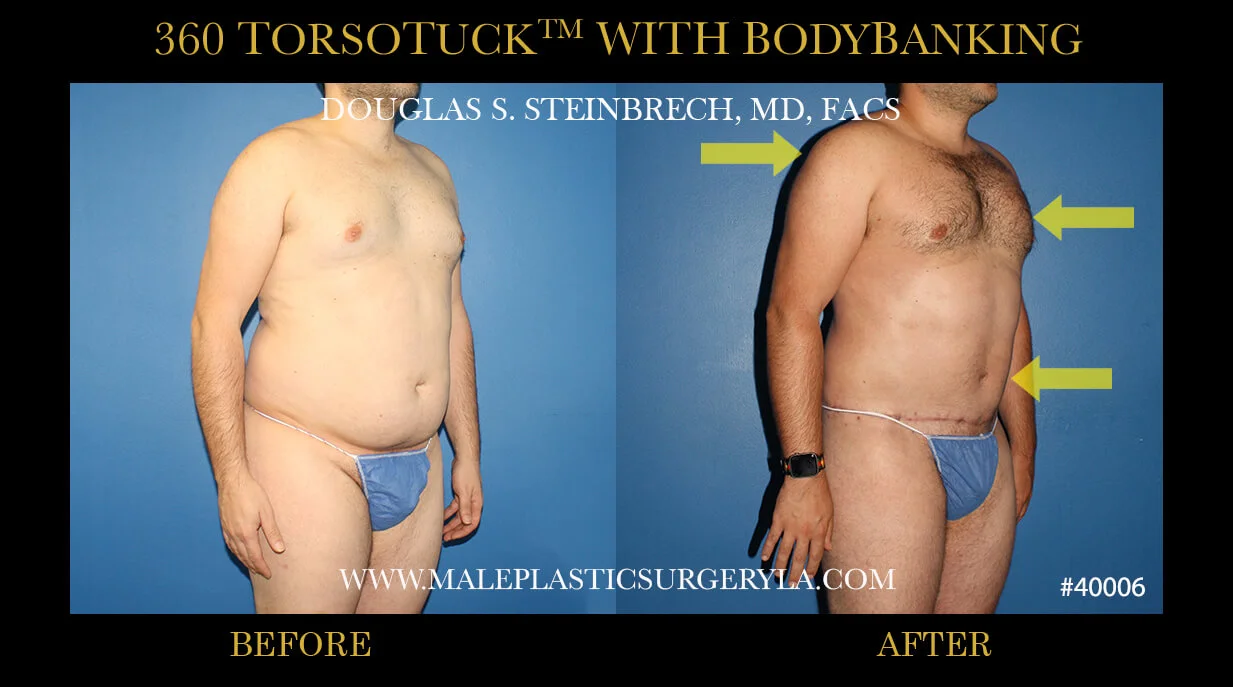 Torsotuck - Before & After Photos