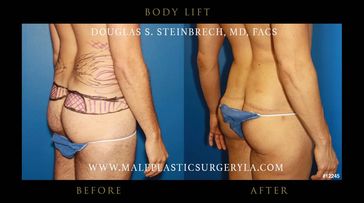 Torsotuck - Before & After Photos