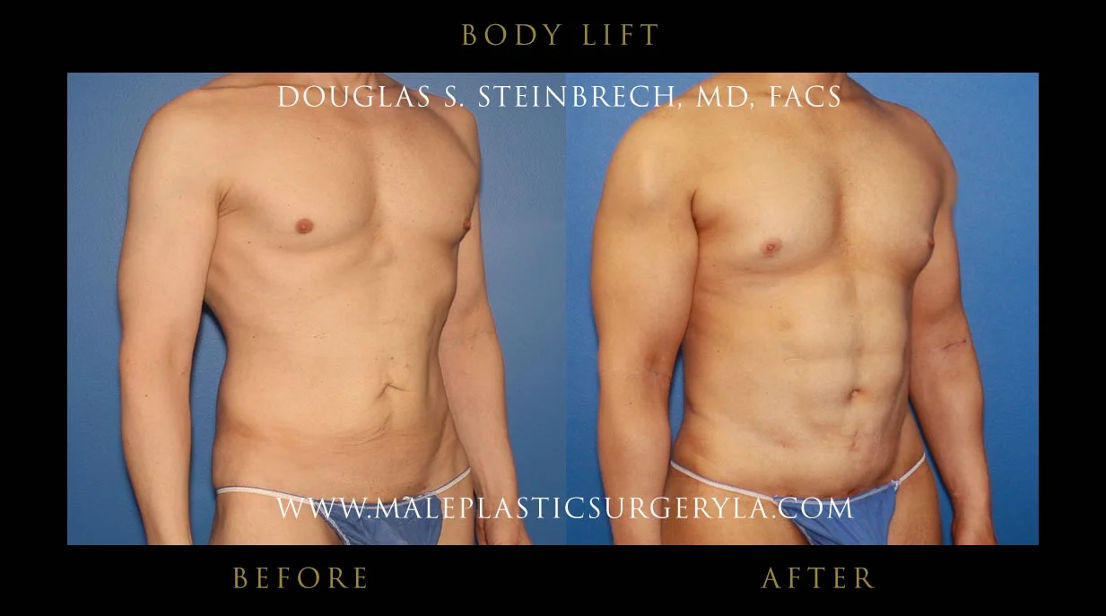 Torsotuck - Before & After Photos