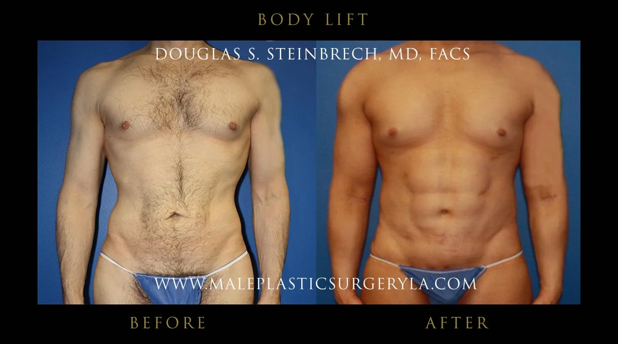 Torsotuck - Before & After Photos