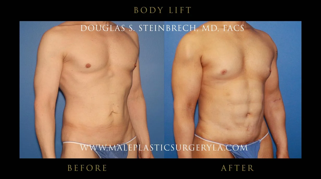 Torsotuck - Before & After Photos