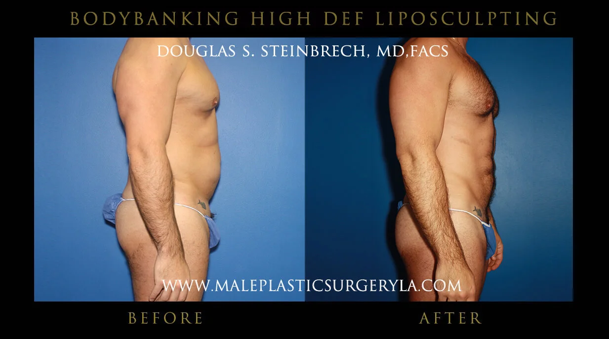 Liposuction - Before & After Photos