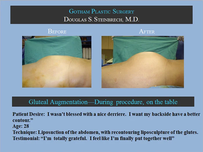 Gluteal Buttock Implants - Before & After Photos