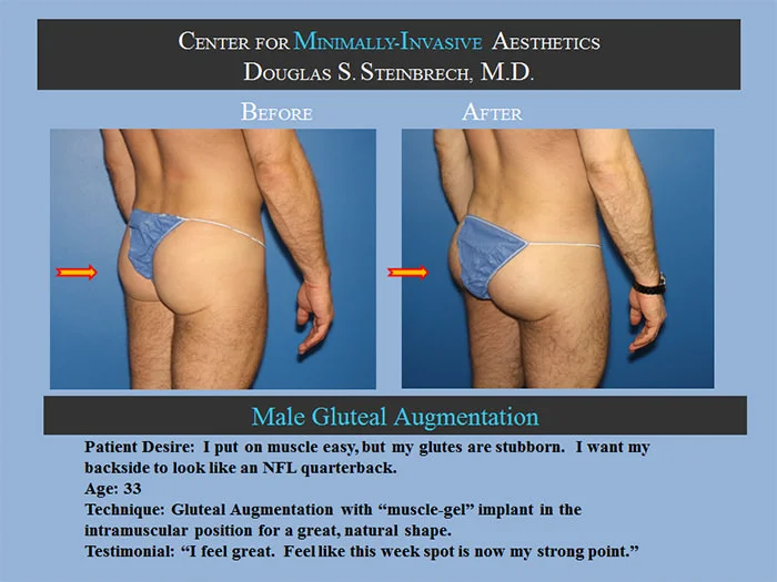 Gluteal Buttock Implants - Before & After Photos