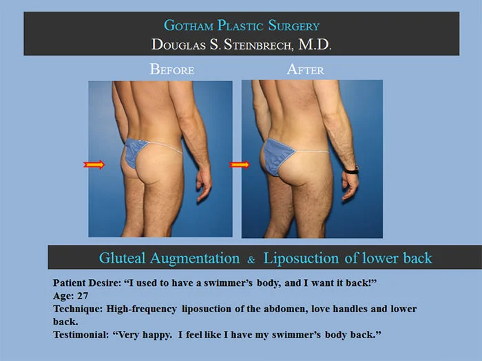 Gluteal Buttock Implants - Before & After Photos