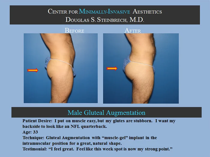 Gluteal Buttock Implants - Before & After Photos