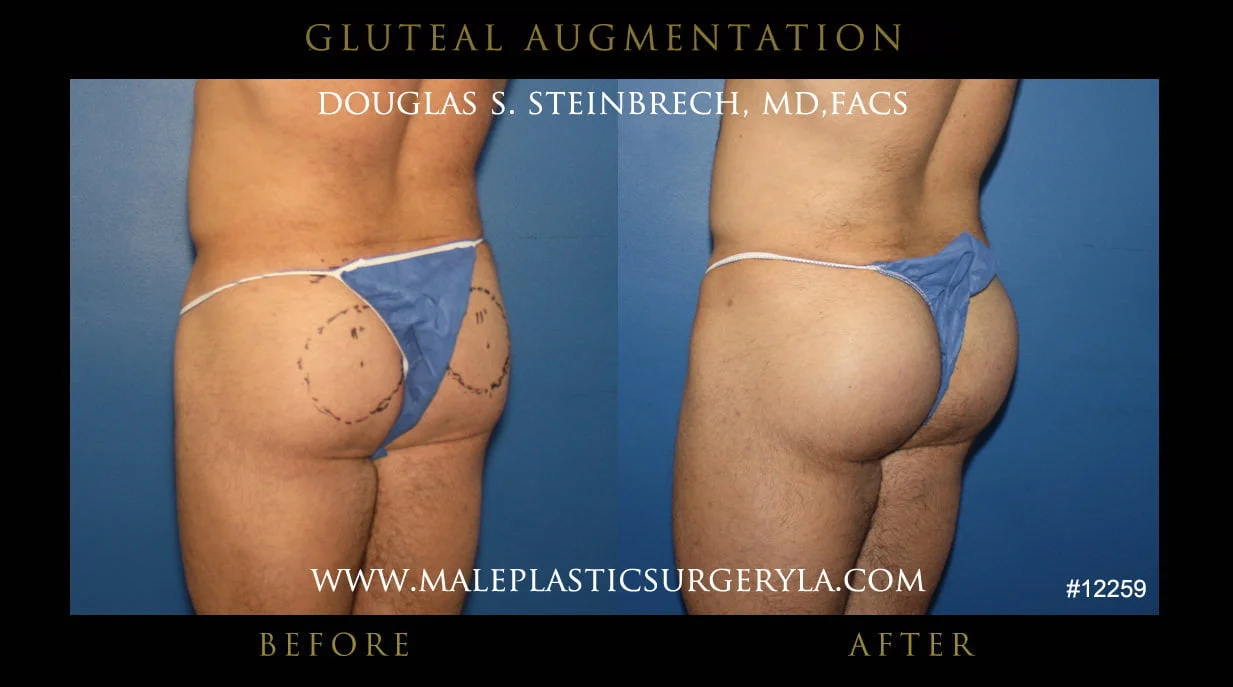 Gluteal Buttock Implants - Before & After Photos