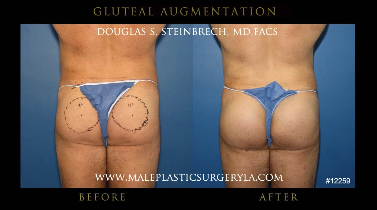 Gluteal Buttock Implants - Before & After Photos