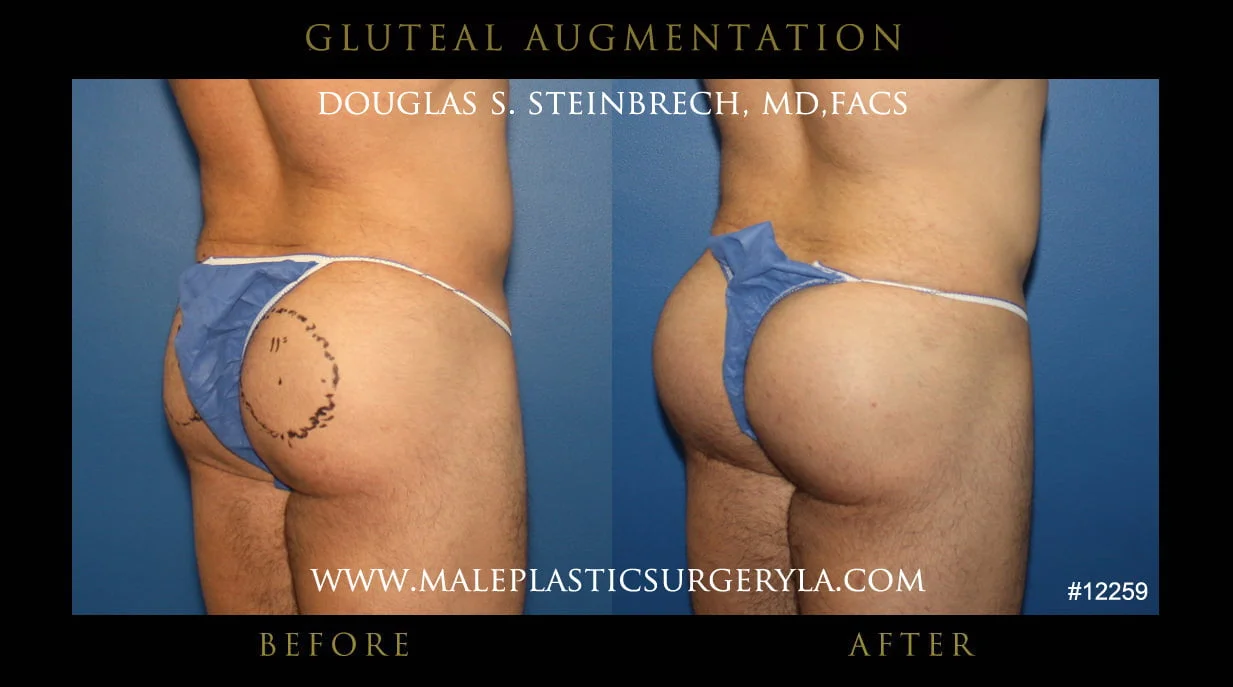 Gluteal Buttock Implants - Before & After Photos