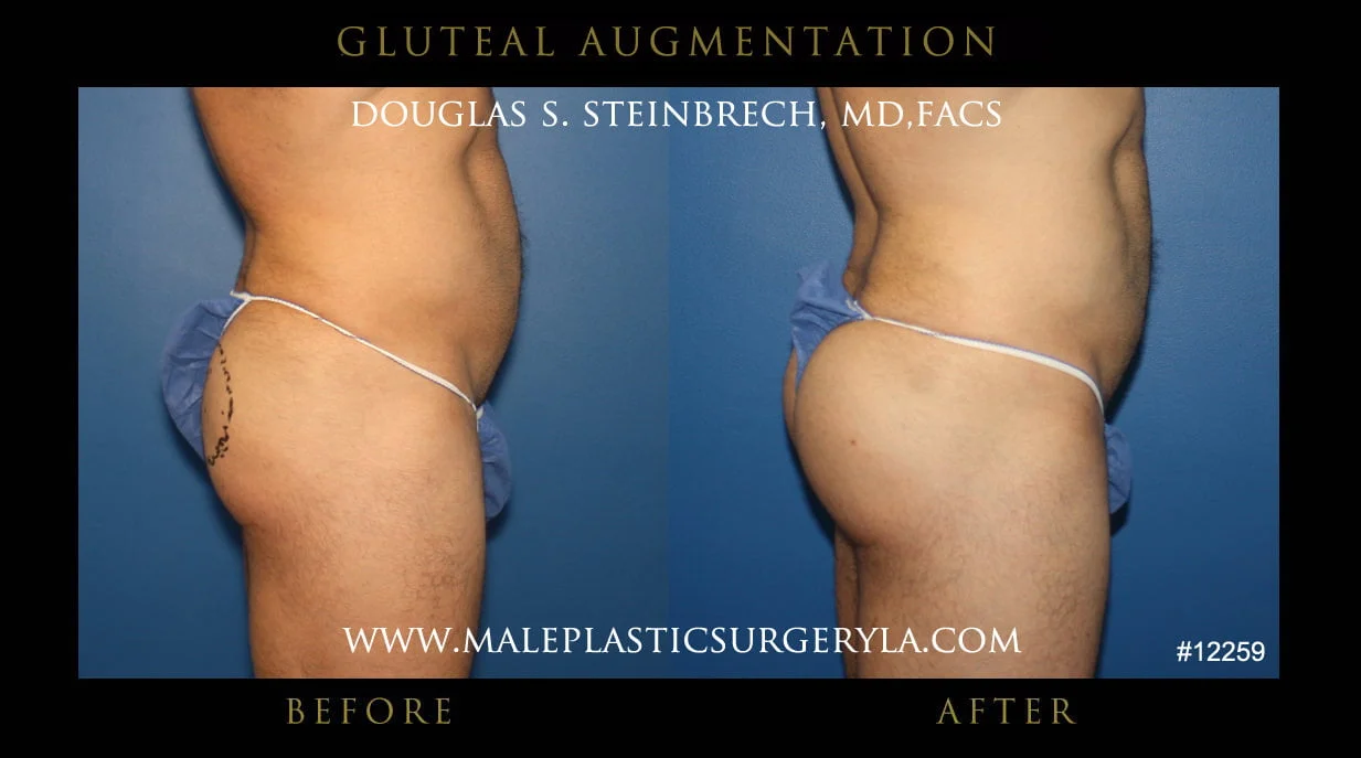 Gluteal Buttock Implants - Before & After Photos