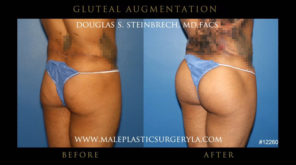 Gluteal Buttock Implants - Before & After Photos