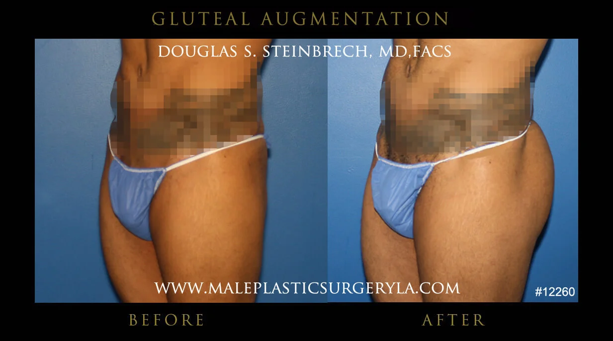 Gluteal Buttock Implants - Before & After Photos