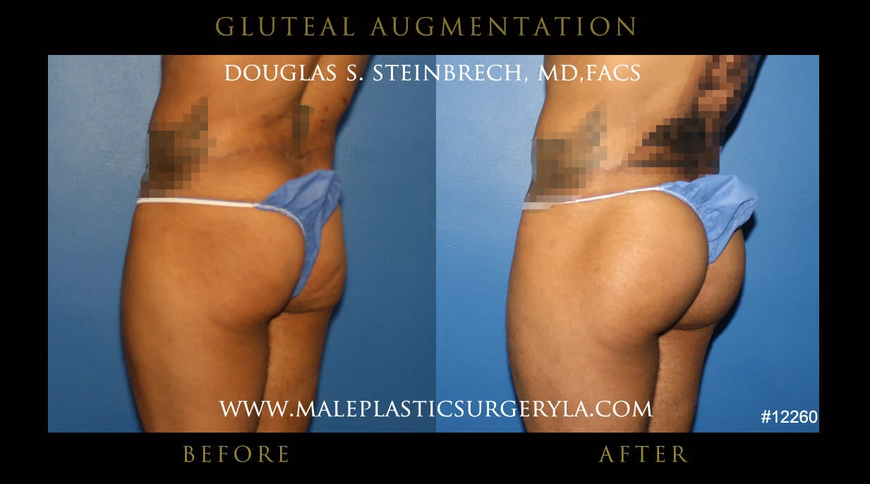 Gluteal Buttock Implants - Before & After Photos