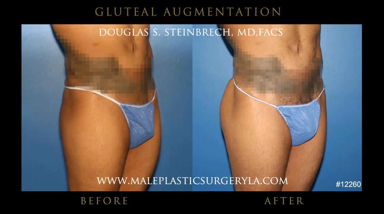 Gluteal Buttock Implants - Before & After Photos