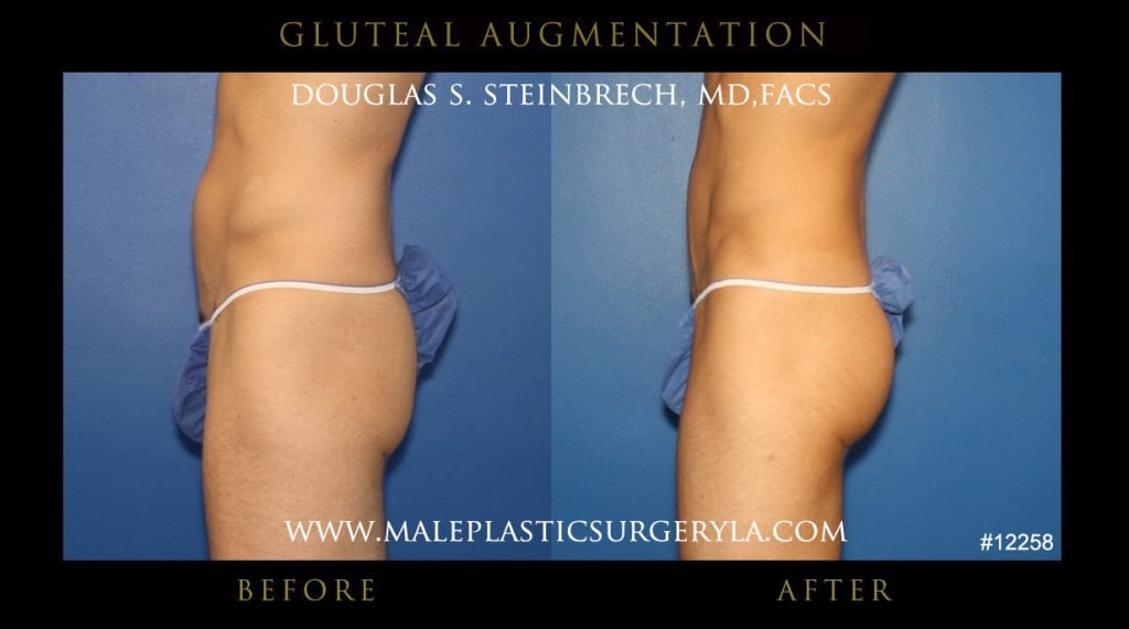 Gluteal Buttock Implants - Before & After Photos