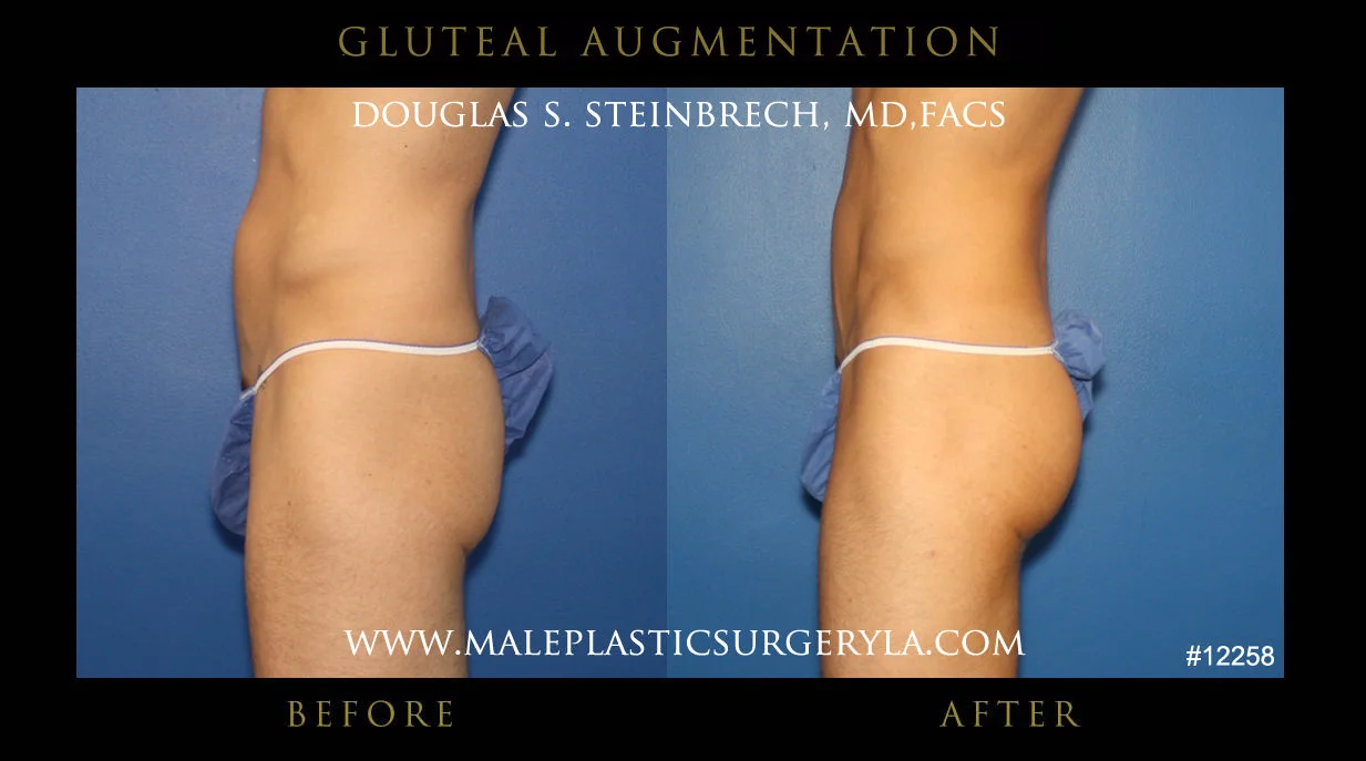 Gluteal Buttock Implants - Before & After Photos