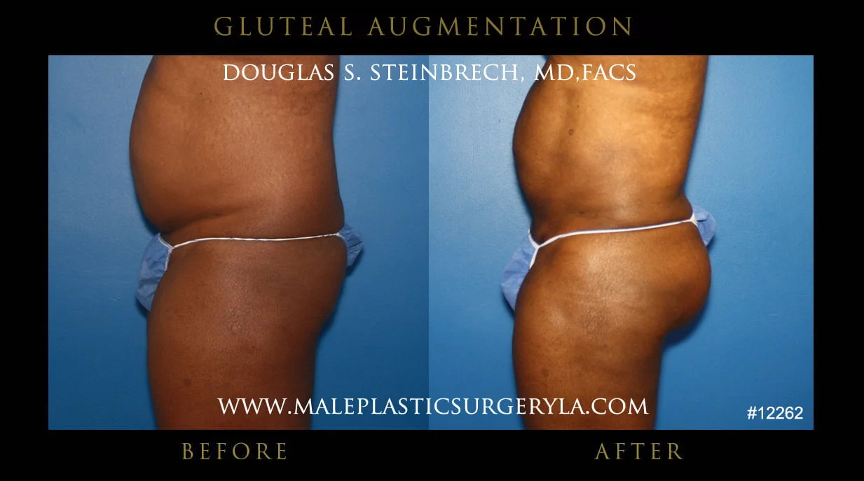 Gluteal Buttock Implants - Before & After Photos