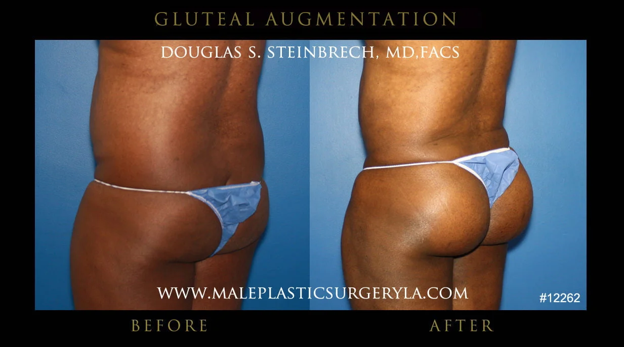 Gluteal Buttock Implants - Before & After Photos