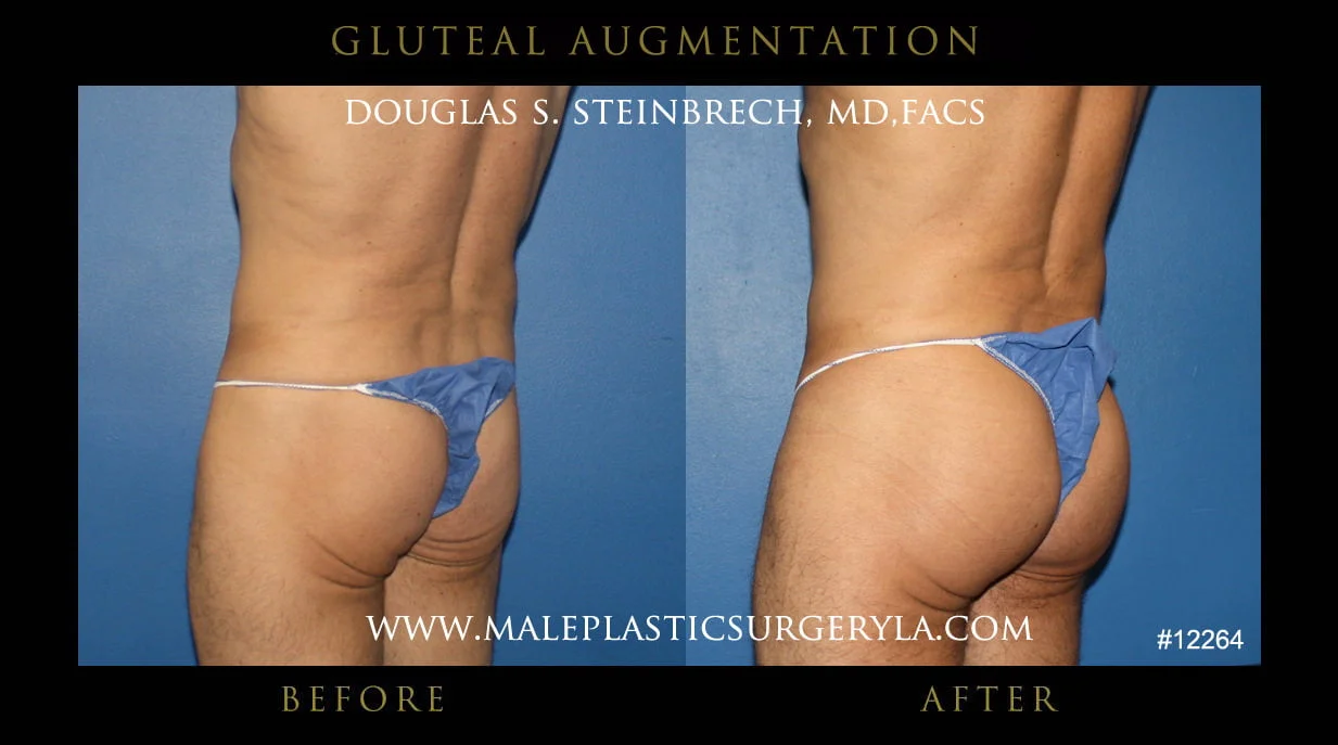 Gluteal Buttock Implants - Before & After Photos